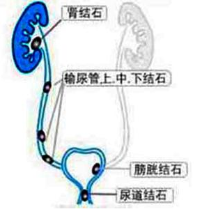 得了尿道结石要怎么检查