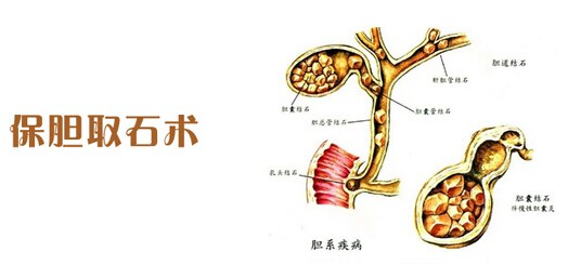 三镜联合 保胆取石医院有什么优势